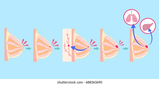 Cartoon Breast Cancer On The Blue Background