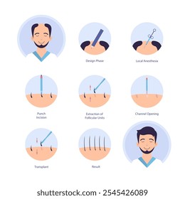 Cartoon Cor Processo de Transplante de Cabelo Alopecia e Tratamento de Perda de Cabelo Conceito Infográfico Estilo de Design Plano. Ilustração vetorial