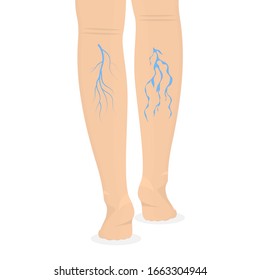 Cartoon Farbe menschlichen Beine und Varikose Veins Gesundheitskonzept. Vektorillustration