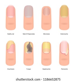 Cartoon Color Nail Diseases Icon Set Element Problem Toenail Concept Flat Design Style. Vector illustration of Nails