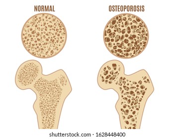 Cartoon Color Osteoporosis Bones Ad Poster Card Skeletal Health Concept Flat Design. Vector Illustration Of Spongy Texture Bone