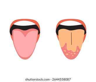 Cartoon comparison between a healthy tongue and one with candidiasis. Useful for health awareness and medical contentillustration, vector, tongue, healthy, ill, candidiasis, cartoon, comparison, mouth