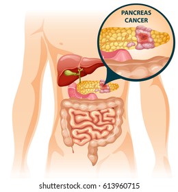 Cartoon digestive human organs concept with liver intestine stomach and sick pancreas vector illustration