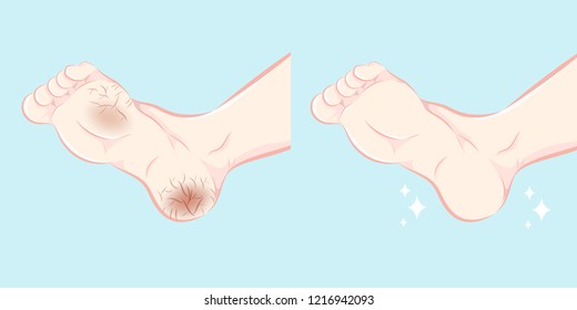 cartoon feet with dry and crack skin before and after treatment
