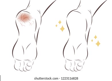 cartoon feet with dry and crack skin before and after treatment