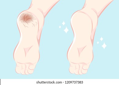cartoon feet with dry skin before and after treatment