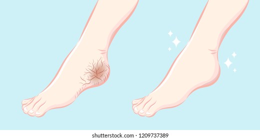 cartoon feet with dry skin before and after treatment