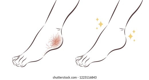 cartoon feet with dry skin before and after treatment