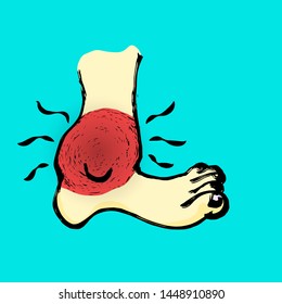 Cartoon Of A Feet With A Throbbing Swollen Ankle. Vector Illustration. 