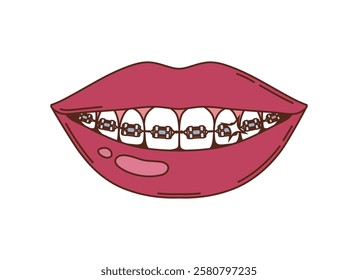 Cartoon groovy smiling lips revealing teeth with braces and wires, symbolizing dental care, orthodontics, oral health, medicine and human body, emphasizing corrective treatment and alignment of teeth