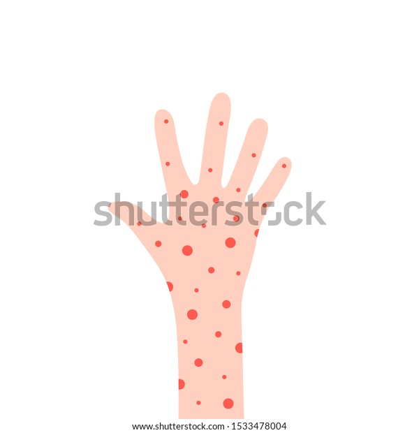 Cartoon Hand Rash Like Allergy Concept Stock Vector (Royalty Free ...