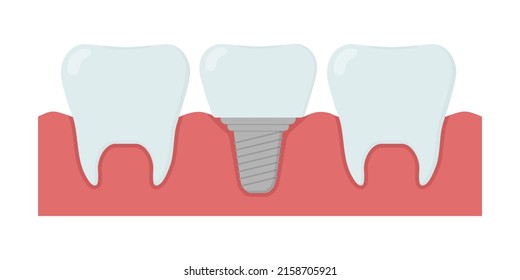 Cartoon healthy teeth and dental implant. Template for stomatology or dentistry. Isolated vector illustration