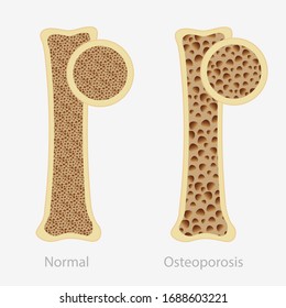 Cartoon human osteoporosis and normal healthy bone vector flat illustration. Sponge structure of disease person anatomy and health skeletal isolated on white. Orthopedic illness problem