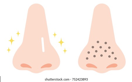 cartoon illustration of clogged pores and clean pores on nose 