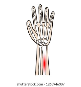 Cartoon illustration of hand and arm with arm injury,Hand drawn,Vector,Illustration,Doodle.