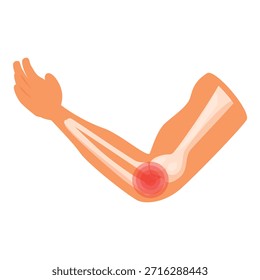 Ilustración de dibujos animados de un brazo humano con huesos y articulación del codo dolorosa