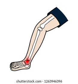 Ankle Sprain Ankle Injury Cartoon