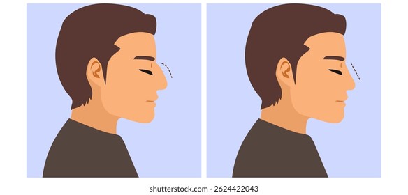 Cartoon illustration of a male patient profile showing before and after rhinoplasty surgery. Cosmetic plastic surgery concept for nose reshaping, aesthetic improvement, and facial enhancement. Drawing