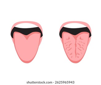 Cartoon illustration showing a close-up comparison between a healthy tongue and a fissured cracked tongue. Educational and medical concept for oral health awareness