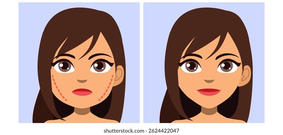 Ilustração em desenho animado de um rosto de mulher mostrando antes e depois da cirurgia facial estética. Conceito para reconstrução do contorno da bochecha e mandíbula, elevação facial e realce estético