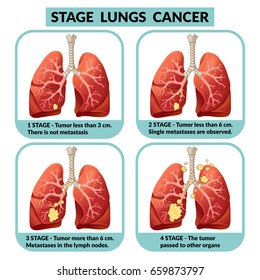 Cartoon internal human organ disease concept with four stages of lungs cancer. Vector illustration.