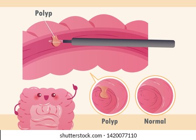 cartoon intestine introduce polypectomy using colonoscopy on yellow background