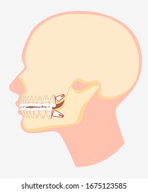 Cartoon model of human dental jaw side view vector flat illustration. Skull image with wisdom tooth pushing adjacent teeth isolated on white background. Dentistry surgery problem