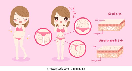 Cartoon pregnant woman with stretch marks concept before and after