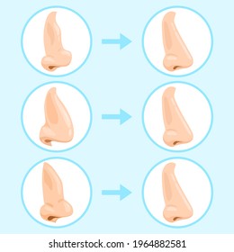 Cartoon rhinoplasty surgery. Rhinoplasty before and after, nose plastic surgery result. Rhinoplasty surgery infographic vector illustration set. Nose rhinoplasty surgery, cosmetic and beauty procedure