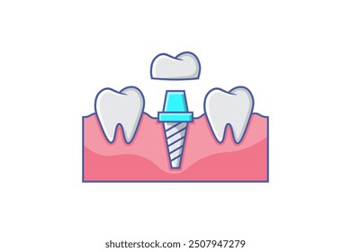 cartoon style dental implant installation illustration vector
