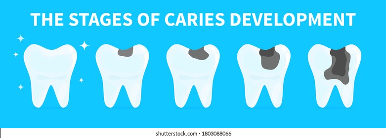 Cartoon teeth shows stages of caries development. Concept of gingivitis, pulpitis and periodontitis. Infographic flat vector illustration of unhealthy tooth
