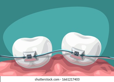 cartoon teeth with steel braces