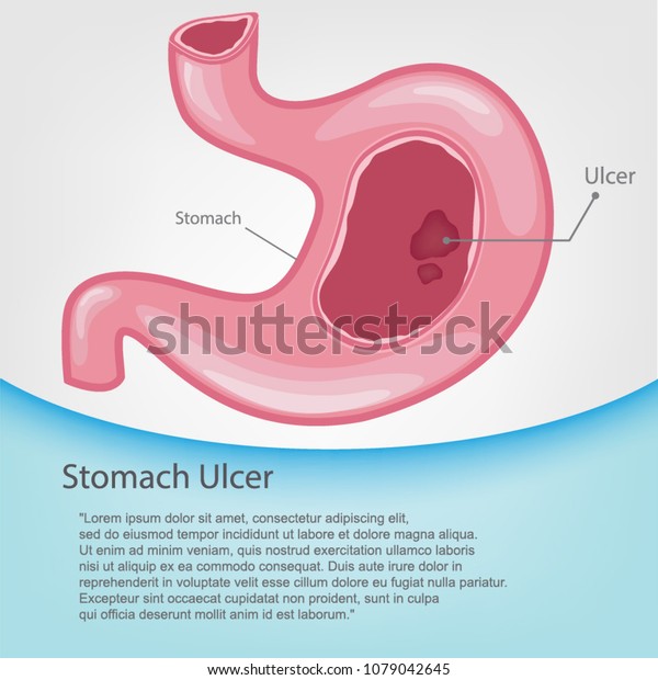 Cartoon Vector Illustration Stomach Ulcers Stock Vector (Royalty Free ...