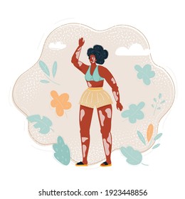 Cartoon vector illustration of vitiligo girl