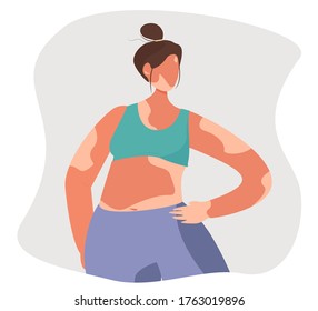 Cartoon Vector illustration of Vitiligo Woman.White Pigment Autoimmune Disease with Pigment Loss.Skin Depigmentation and Genetic Illness.Body positive concept.Skin Disease and Pimples
