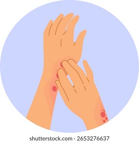 A cartoon vector showing close-up of female hands scratching irritated skin with rash, perfect for dermatology, skincare or medical awareness content