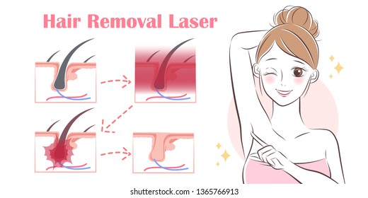 cartoon woman remove hair with laser under her arms