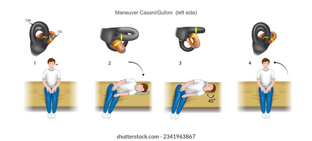 Casani Gufoni maneuver, a practical guide to the treatment of benign positional paroxysmal vertigo (bppv). With damage to the left ear. Diagram of the structure of the inner ear. Vector. 