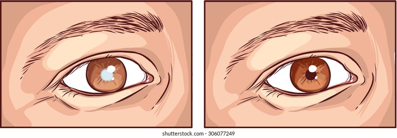 cataract