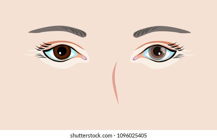 Cataract :a clouding of the normally clear lens of your eye