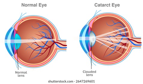 Anatomia da catarata. Nuvem do cristalino do olho, que muitas vezes resulta em visão embaçada ou nebulosa. Diagrama da íris marrom. Ilustração vetorial