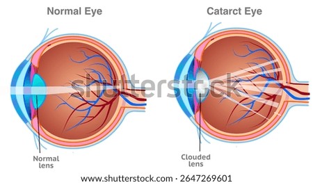 Cataract anatomy. Clouding of the eye’s lens which often results in blurry or hazy vision. Brown iris diagram. Vector illustration