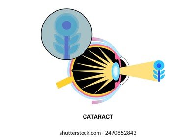 Cataract disease, eye and pupil anatomy. Lens clouding, vision impairment, and potential blindness. Vision problems during aging. Human vision loss concept. Blindness flat vector medical illustration