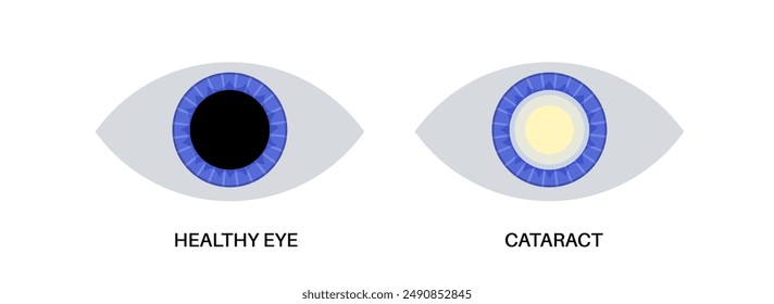 Cataract disease, eye and pupil anatomy. Lens clouding, vision impairment, and potential blindness. Vision problems during aging. Human vision loss concept. Blindness flat vector medical illustration