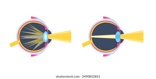 Cataract disease, eye and pupil anatomy. Lens clouding, vision impairment, and potential blindness. Vision problems during aging. Human vision loss concept. Blindness flat vector medical illustration