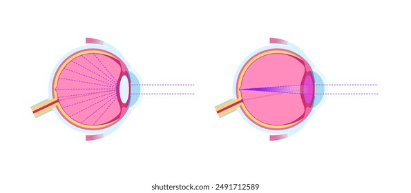 Cataract disease, eye and pupil anatomy. Lens clouding, vision impairment, and potential blindness. Vision problems during aging. Human vision loss concept. Blindness flat vector medical illustration