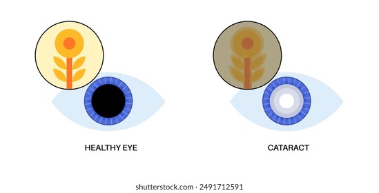 Cataract disease, eye and pupil anatomy. Lens clouding, vision impairment, and potential blindness. Vision problems during aging. Human vision loss concept. Blindness flat vector medical illustration