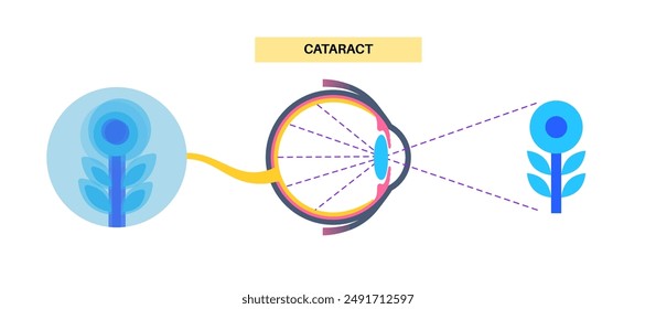 Cataract disease, eye and pupil anatomy. Lens clouding, vision impairment, and potential blindness. Vision problems during aging. Human vision loss concept. Blindness flat vector medical illustration