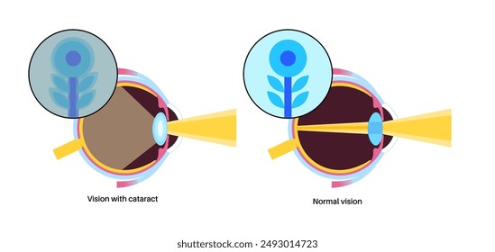 Cataract disease, eye and pupil anatomy. Lens clouding, vision impairment, and potential blindness. Vision problems during aging. Human vision loss concept. Blindness flat vector medical illustration