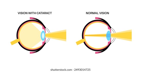 Cataract disease, eye and pupil anatomy. Lens clouding, vision impairment, and potential blindness. Vision problems during aging. Human vision loss concept. Blindness flat vector medical illustration